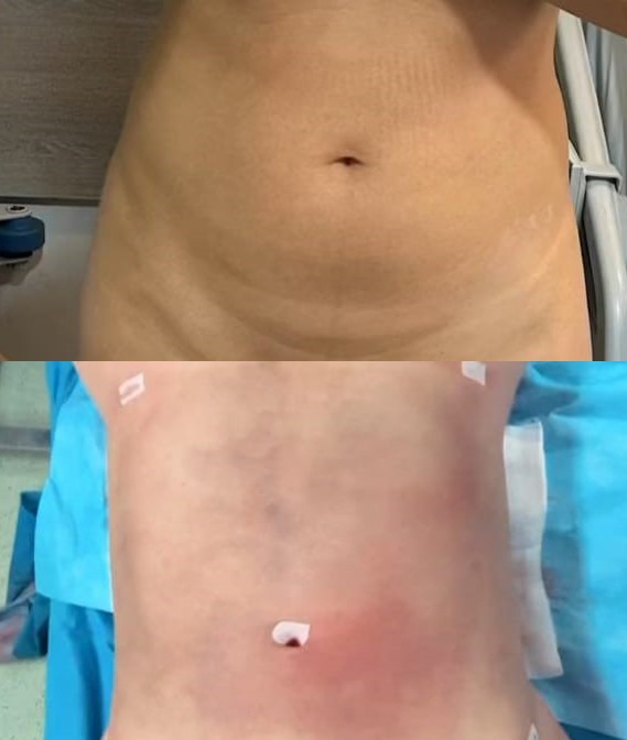 Photo liposuccion abdominoplastie avant et après