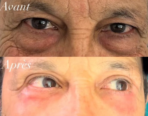 photo Blépharoplastie avant et après