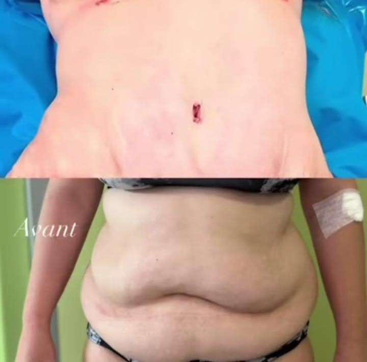 liposuccion abdominoplastie Photo avant et après